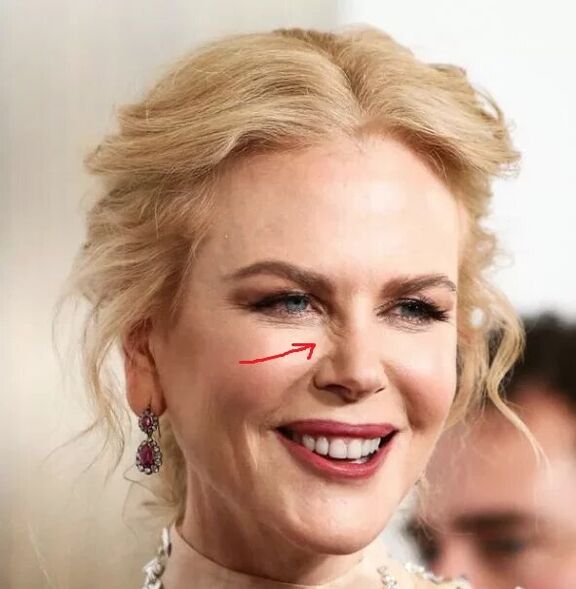 Alternativa për Botox